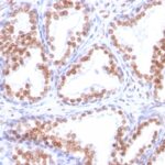 FFPE human prosate adenocarcinoma sections stained with 100 ul anti-Androgen Receptor (clone DHTR/882) at 1:200. HIER epitope retrieval prior to staining was performed in 10mM Tris 1mM EDTA, pH 9.0.